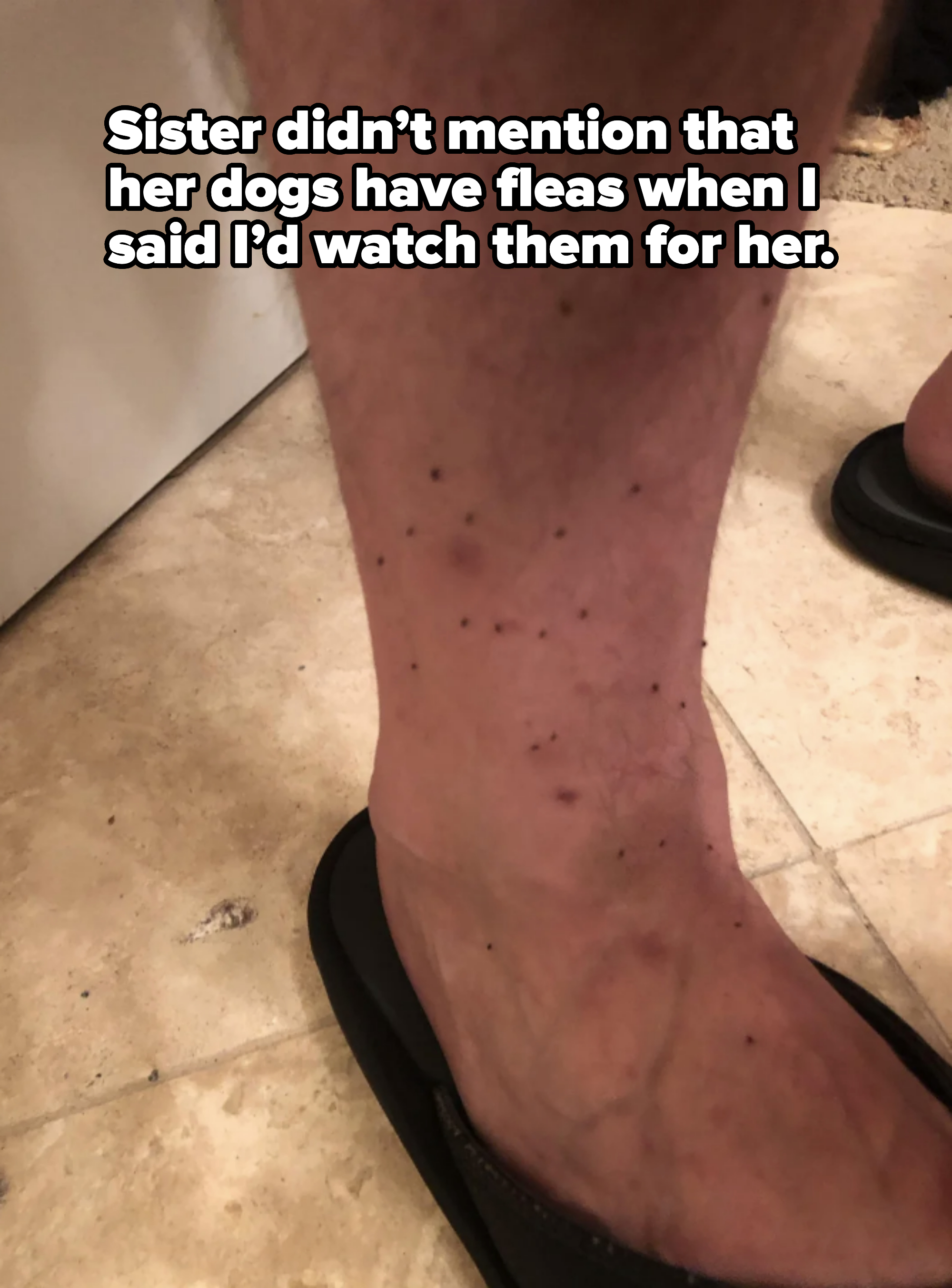 Close-up of a person's lower leg with multiple dark spots, possibly bruises or marks. The person is wearing a flip-flop