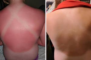 Comparison of a severe sunburn on the left and healthy skin on the right, highlighting the importance of sunscreen