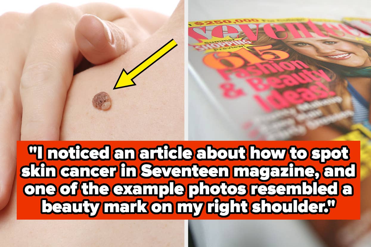 Close-up of a mole on skin, adjacent to a Seventeen magazine cover, captioned "I noticed an article about how to spot skin cancer in Seventeen magazine, and one of the example photos resembled a beauty mark on my right shoulder"