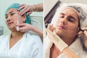 Two individuals receiving cosmetic treatments, one with acupuncture needles and another with pre-surgical markings
