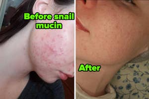 reviewer's skin before and after using snail mucin