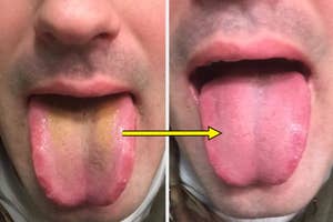 Person showing before and after using a tongue cleaner, highlighting the difference in tongue cleanliness