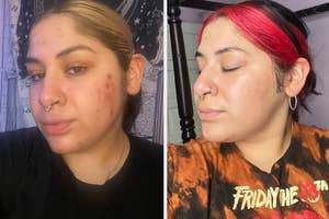 before/after of reviewer's face that looks bright and glowing after using the vitamin c serum - before pic shows skin looking much duller with acne