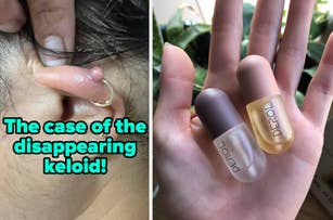Left: Close-up of an ear with a small keloid and text reading "thhe case of the disappearing keloid". Right: Two fingers holding capsules labeled "DEROL."