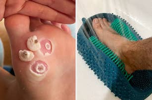 Two images side-by-side; left shows a close-up of a warts removed on a reviewer's foot, right displays a reviewer's foot on a blue shower scrub mat with bristles
