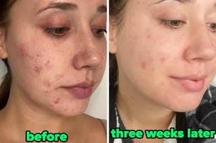 Person's face before and after using skincare product with improved skin clarity over three weeks