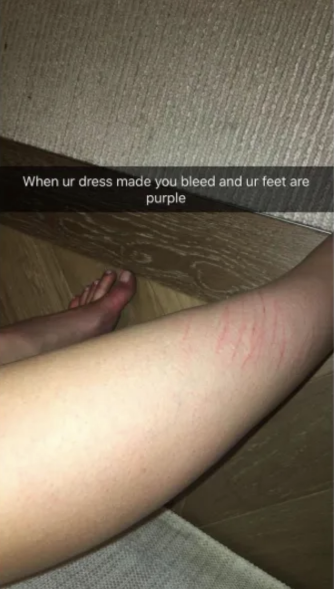 Kylie&#x27;s leg with red marks, and a caption about discomfort from a dress