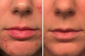 Close-up before and after comparison of a person's lower face showing improvement in skin clarity after using acne spot treatment