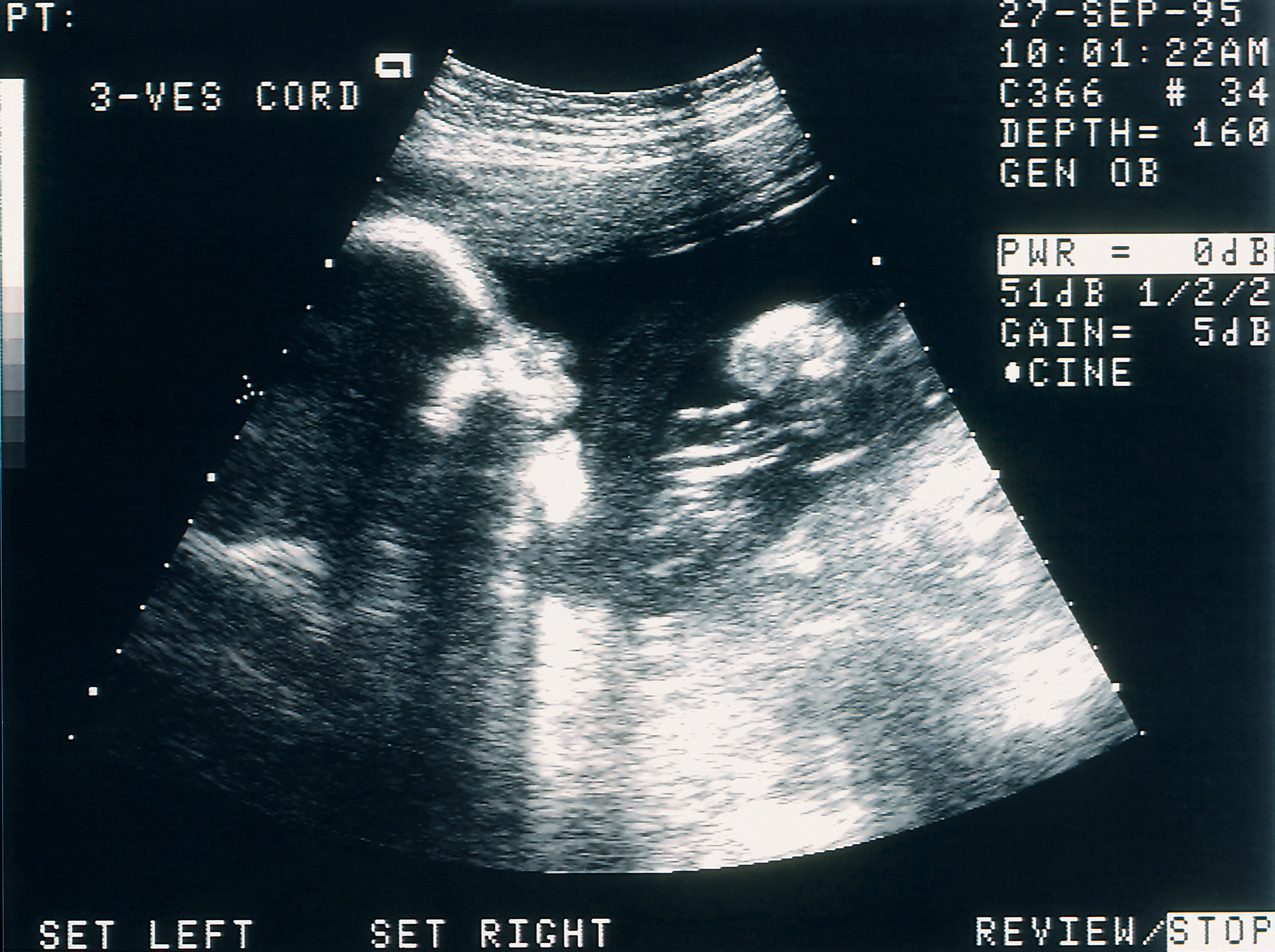 Ultrasound image showing a fetus, indicating a pregnancy announcement related to a wedding-themed article