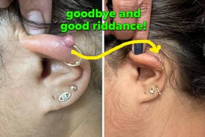 Before and after of an ear with a healed piercing after removal of a keloid "goodbye and good riddance"