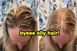Two before and after photos of a person's hairline demonstrating the effectiveness of a dry shampoo product