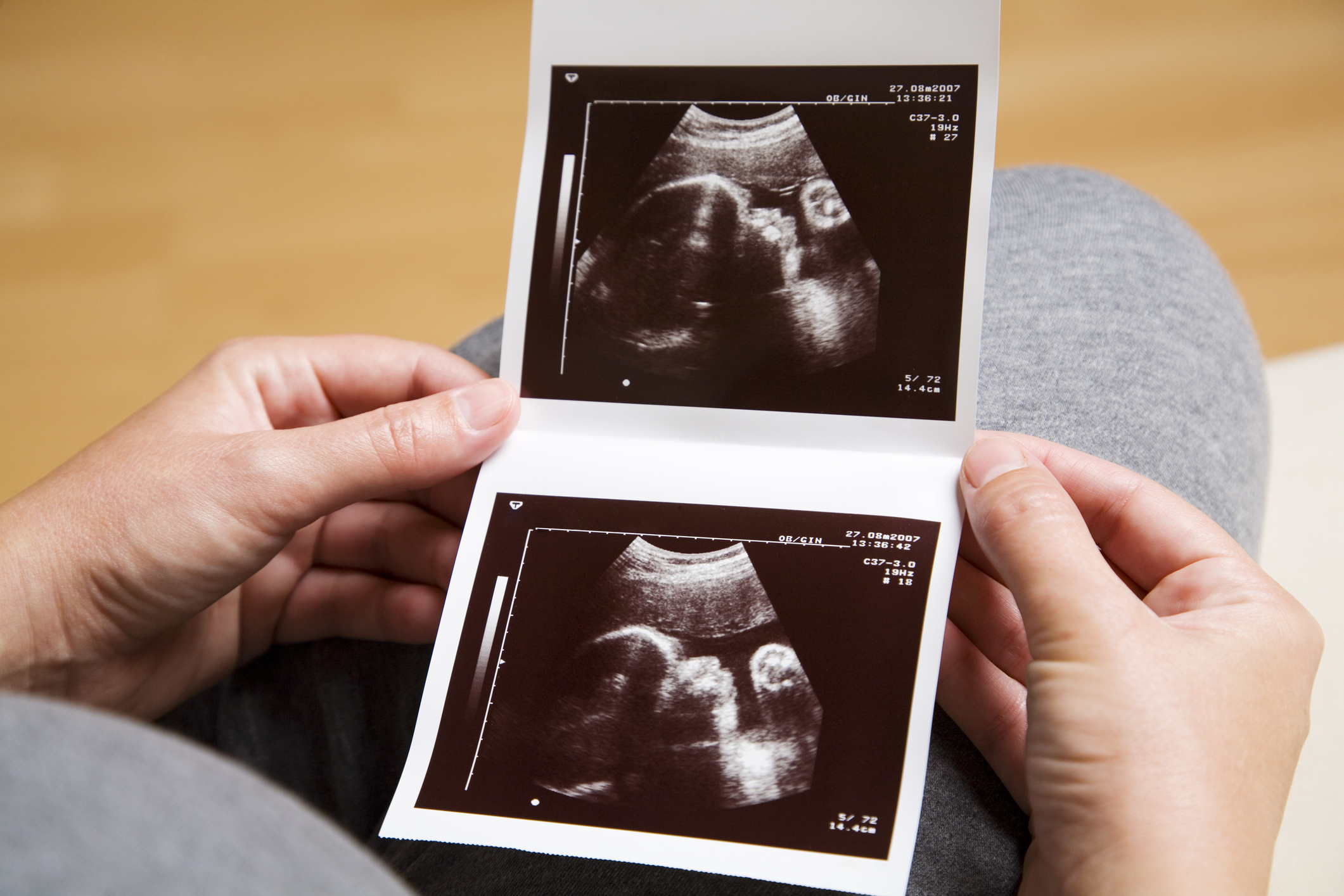 Person holding ultrasound images of a developing fetus in hand, representing a pregnancy
