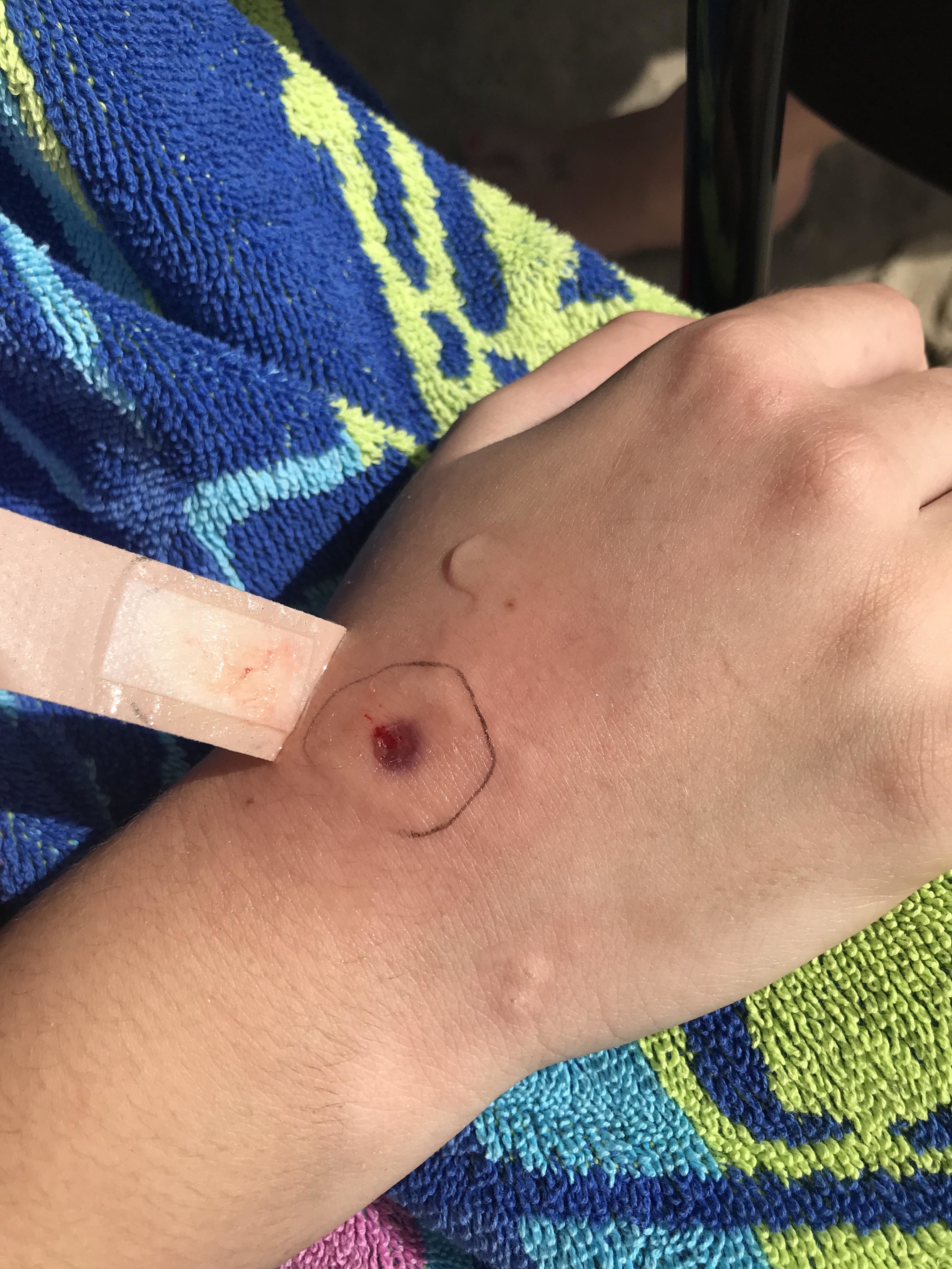 A hand with a minor wound on the back, surrounded by a circle drawn with ink. A bandage is being applied over the wound