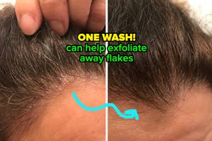 a reviewer's scalp before and after treatment with flakes disappearing after "one wash can help exfoliate away flakes"