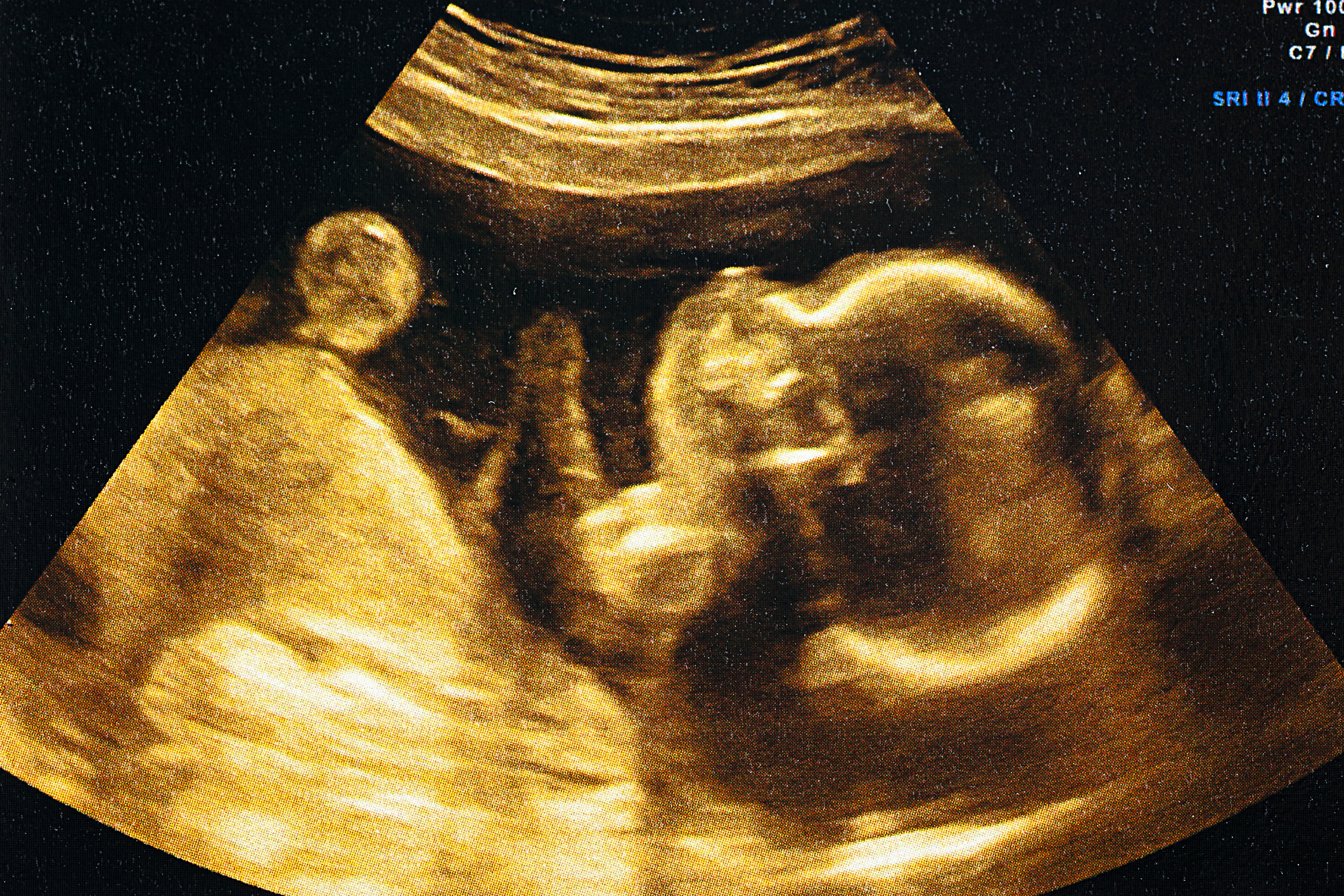 Ultrasound image showing a developing baby in the womb, featured in an article on Sex &amp;amp; Love