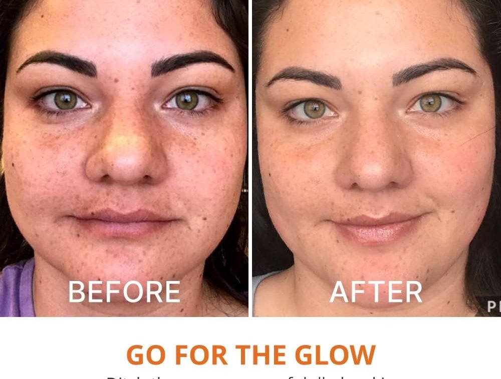 Before and after photo showing a model's improved skin appearance after using a skincare product