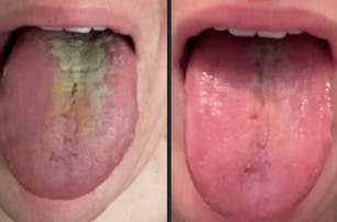 Two side-by-side images showing a before and after of a tongue cleaning product use
