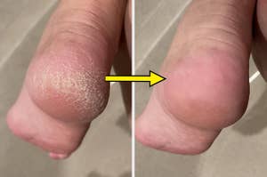 Before and after comparison of a heel treatment on a person's foot