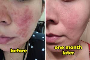 Side-by-side comparison of a person's face before and after skincare treatment, with clearer skin in the 'one month later' photo