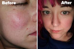 reviewer's before and after photo using La Roche moisturizer