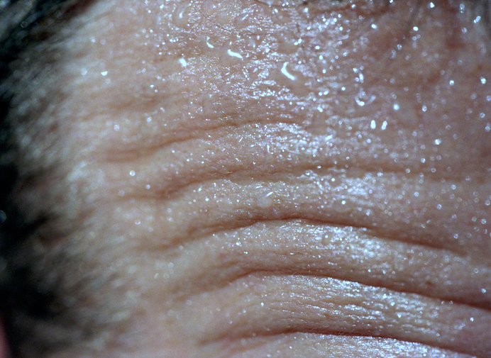 Close-up of a person's sweaty forehead with visible wrinkles