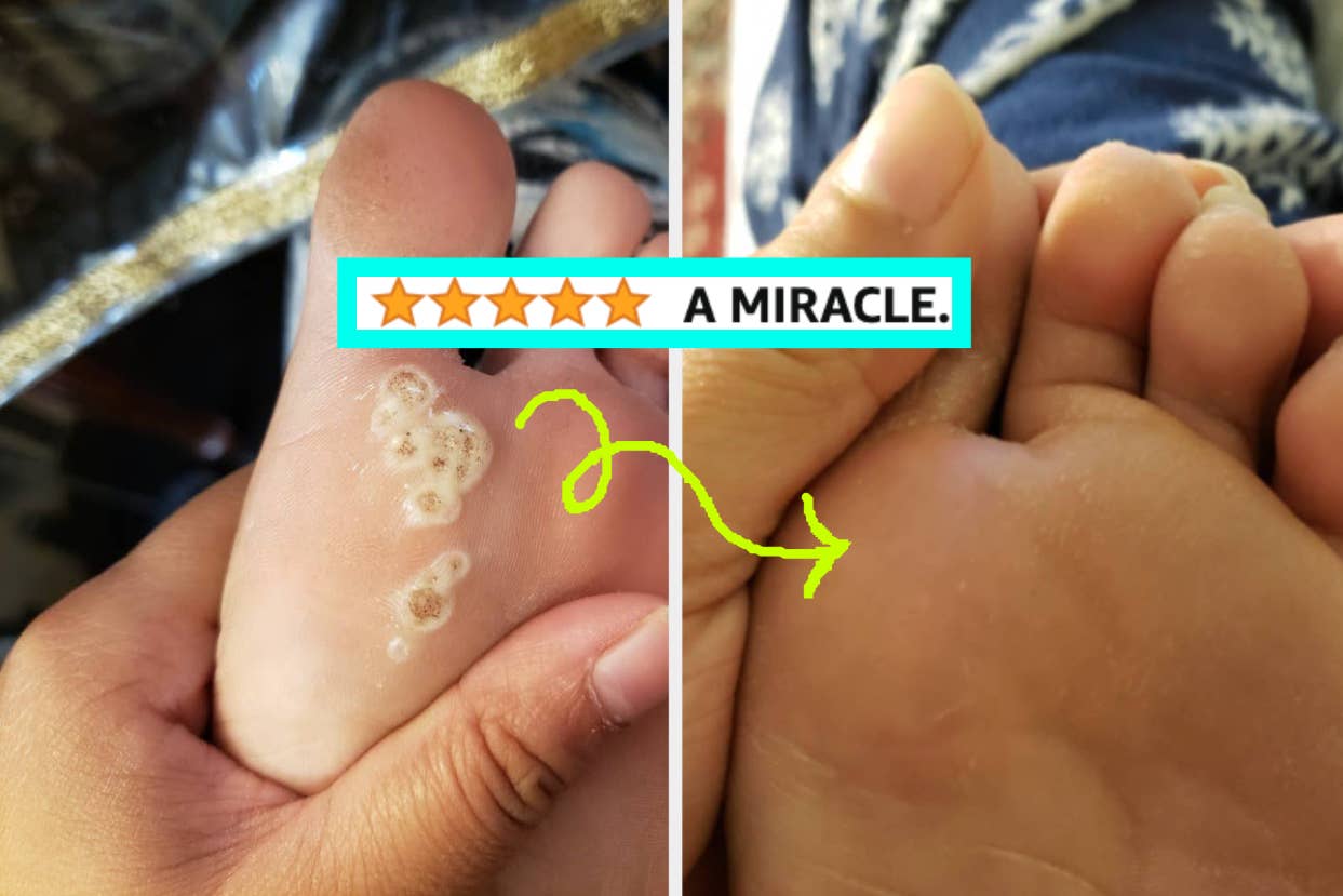 reviewers foot with warts and then same foot with warts gone after using gel remover for warts