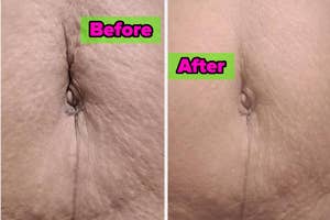 reviewer stomach with loose skin and then same reviewer stomach with tightened skin after using Brazilian Bum Bum cream