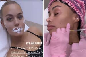 Lottie Tomlinson and Blac Chyna getting their fillers dissolved