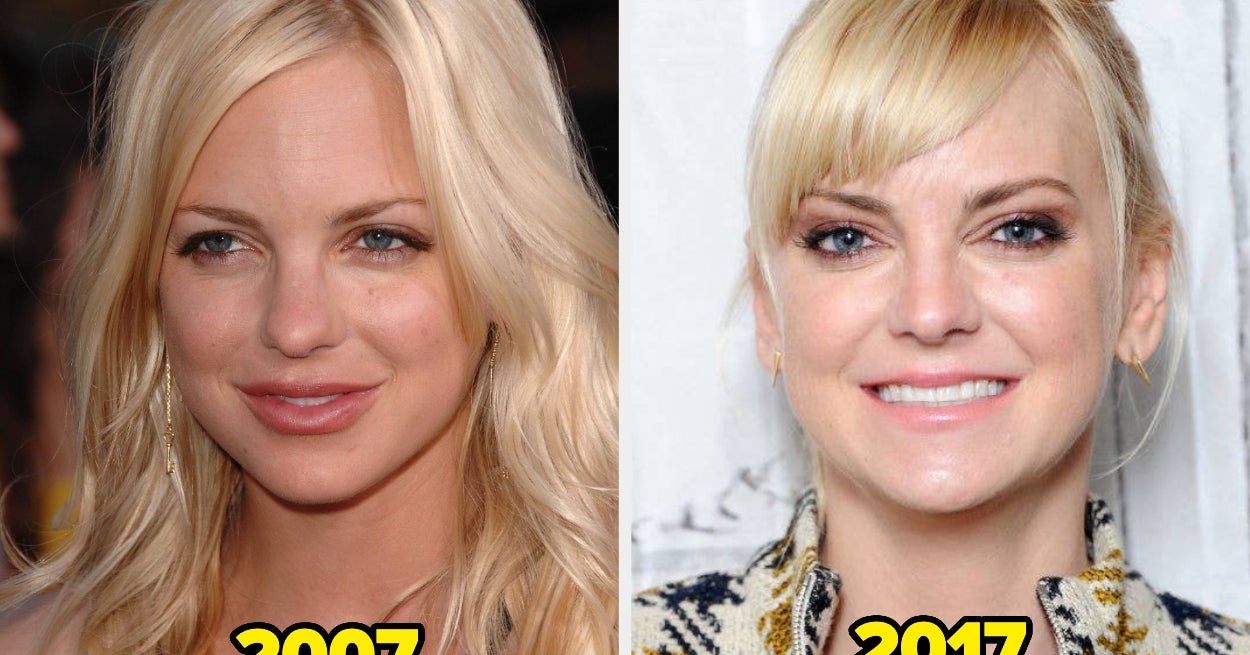17 Celebs Who Dissolved Or Stop Getting Facial Fillers (And Why)