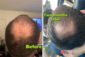 reviewer's thinning hair before using biotin shampoo, then same reviewer's hair thickening after using shampoo