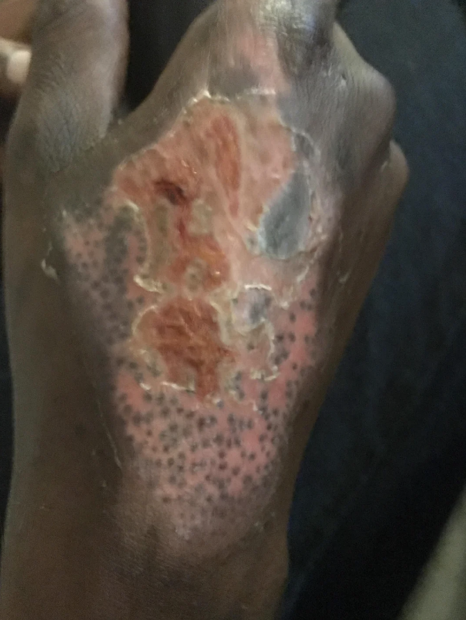 Close-up of a person&#x27;s foot with a healing wound and dotted skin pattern, possibly from a medical condition or treatment