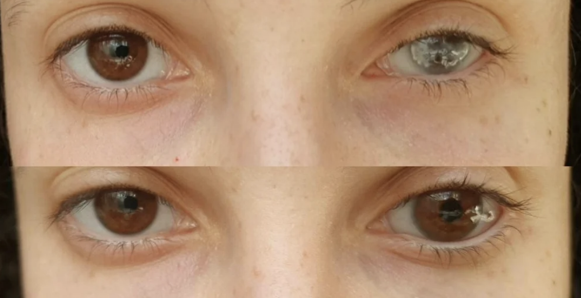 Closeup of a person&#x27;s eyes showing how prosthetics improve the eye