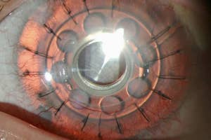 eye with corneal implant