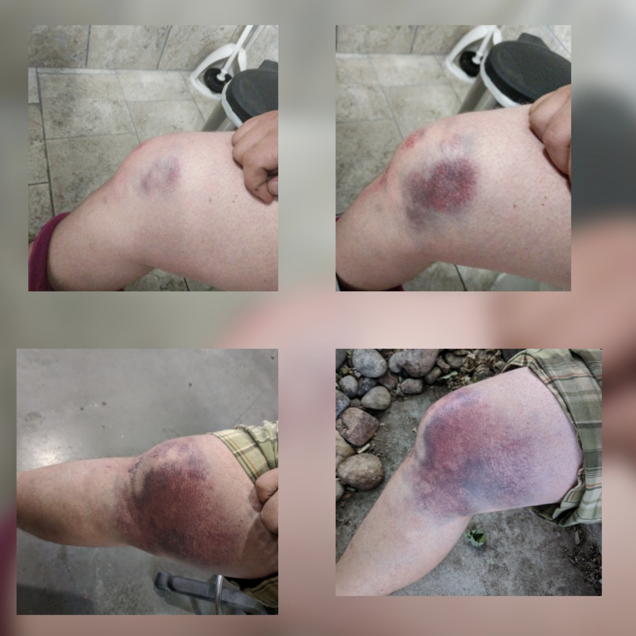 Four-angle view of a person&#x27;s bruised knee following an injury