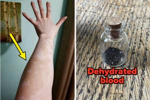 person with vitiligo and dehydrated blood