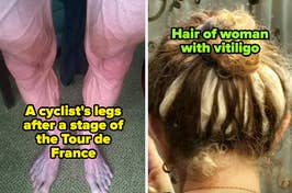 A cyclist's legs after a stage of the Tour de France and the Hair of woman with vitiligo