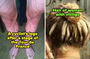 A cyclist's legs after a stage of the Tour de France and the Hair of woman with vitiligo