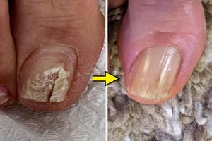 an infected toe nail before and after treatment