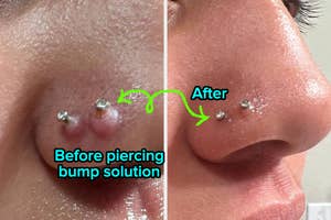 reviewer's nose with keloids and then keloid size reduced after using solution