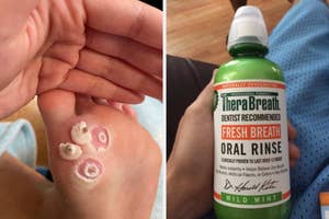 wart bandages and therabreath