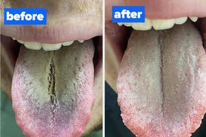 Before and after images showing improvement in a person's tongue condition