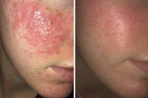 Before and after comparison of a person's cheek showing improvement in skin texture, possibly for a skincare product