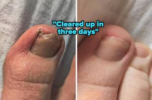 left: reviewer's fungal toenail / right: after treatment, nail is healthy and clear with no signs of fungus
