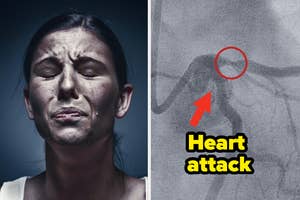 Split image: left shows a woman grimacing, right displays an x-ray with "Heart attack" text and an arrow pointing to a spot