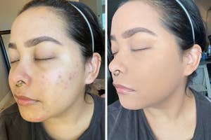 reviewer before using powder foundation and same reviewer after with dark spots covered using the foundation