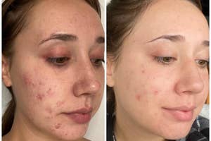 Reviewer's results of using Differin gel after three weeks, with the before picture showing breakouts all over their face and the after photo showing their face noticeably clearer with breakouts mostly healed