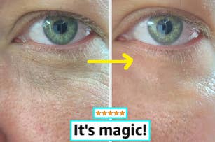 Before and after comparison of a person's under-eye area, with a text banner reading "It's magic!" and a five-star review graphic