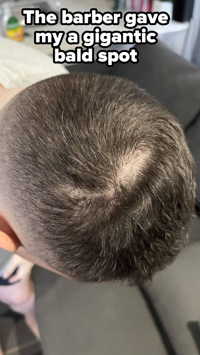 A close-up view of the top of a person's head showing thinning hair and a visible patch of scalp