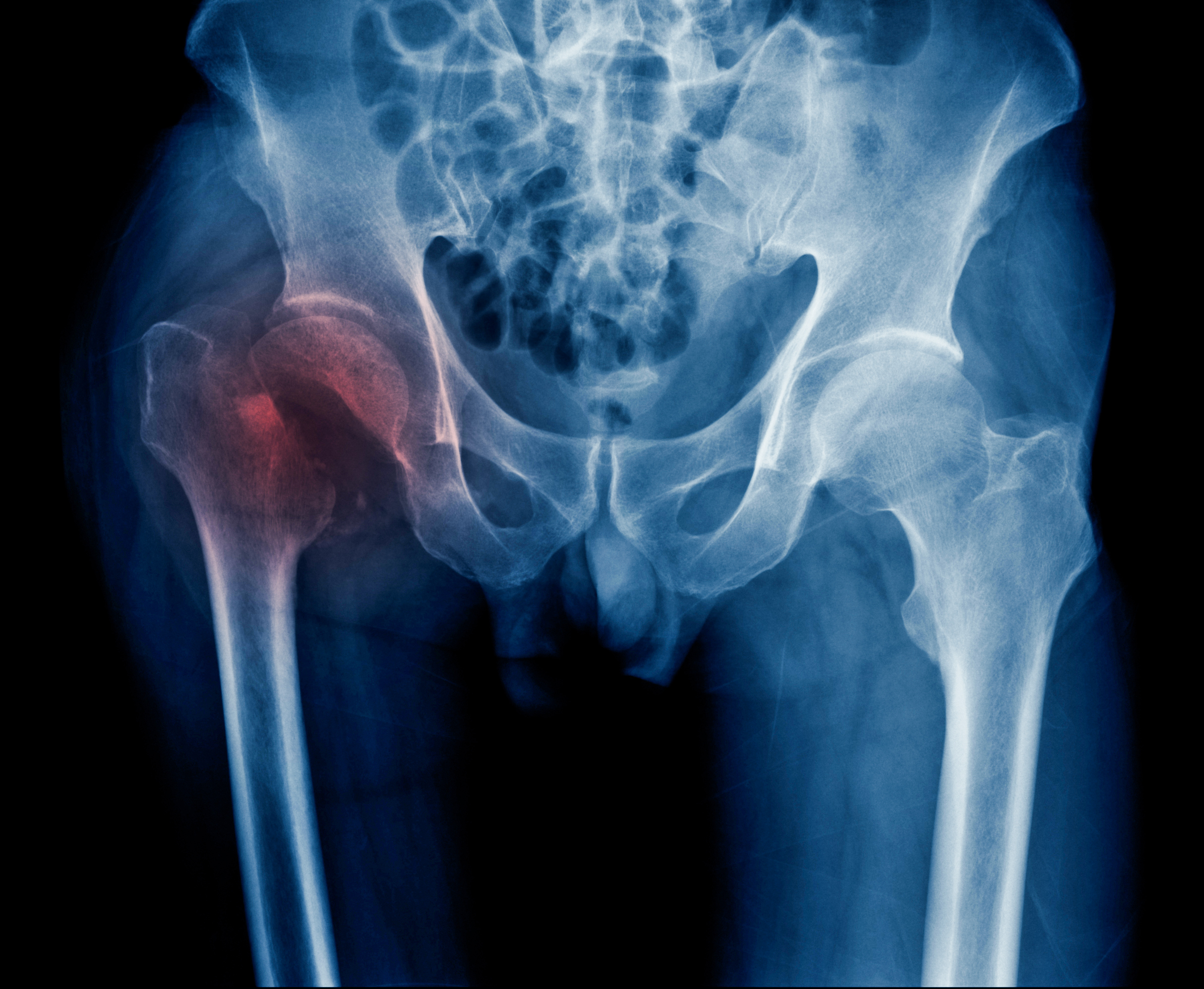 X-ray image of a human pelvis showing a noticeable fracture or abnormality on the left femur near the hip joint