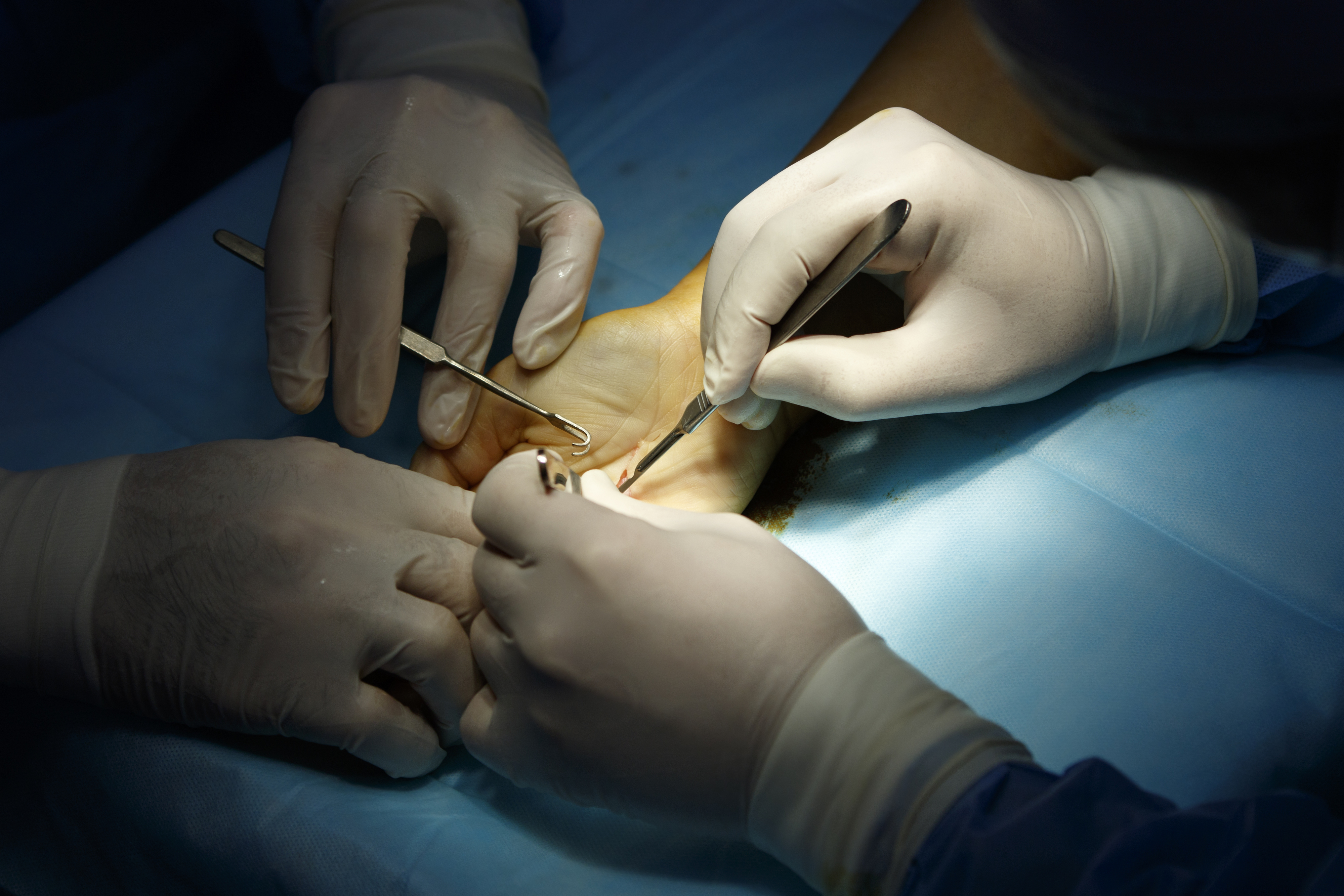 Close-up of surgeons&#x27; gloved hands performing surgery on a patient&#x27;s foot. Surgical instruments and a blue drape are visible